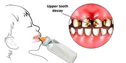 Baby Bottle Syndrome - falling asleep while having a bottle or breast fed. Kids Dental. German Dentist Marbella, San Pedro.