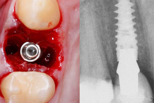 NobelActive Immediate Implant Primary Stability. German Dentist Marbella, San Pedro