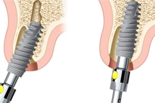 NobelActive Immediate Implant Implant Position. German Dentist Marbella, San Pedro