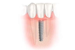 NobelActive Immediate Implant Place Implants. German Dentist Marbella, San Pedro