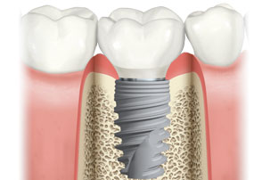 NobelActive Immediate Implant Natural Molar. German Dentist Marbella, San Pedro