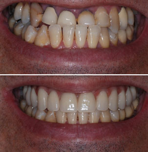 NobelActive Immediate Implant. Before After Full-Arch Restoration. German Dentist Marbella, San Pedro