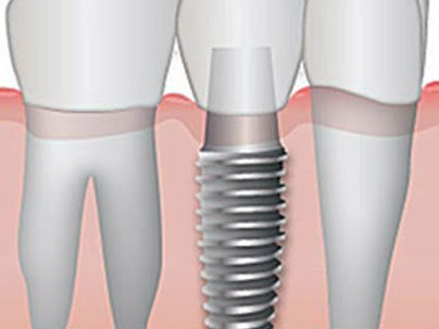 Dental treatments: Dental Implants German Dentist Marbella, San Pedro
