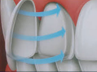 Dental treatments: High Tech Ceramic Veneers German Dentist Marbella, San Pedro