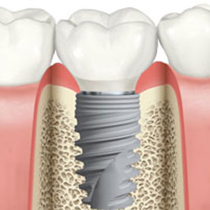 Immediate Dental Implant. Clínica Dental San Pedro, Marbella