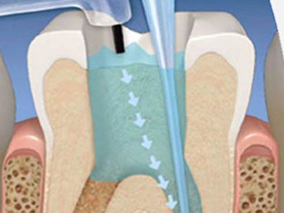 Root Canal Treatment German Dentist Marbella, San Pedro