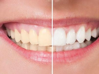 Dental treatments: Teeth Whitening German Dentist Marbella, San Pedro