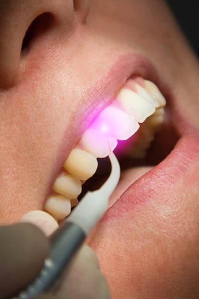 Dental Laser can avoided local anesthesia, replacing the dental drill and scalpe. German Dentist Clinic Marbella San Pedro
